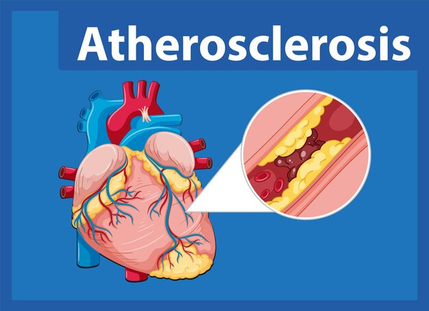 Infografía sobre anatomía humana y aterosclerosis en educación científica