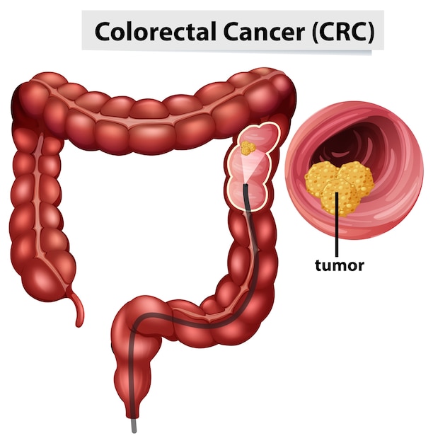 Vector gratuito infografía sobre el cáncer colorrectal (ccr) para la educación