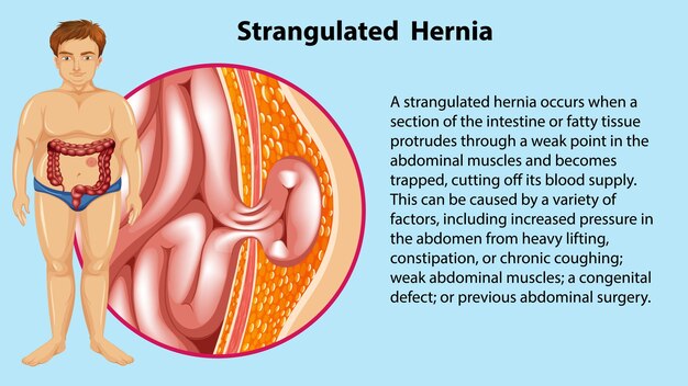 Infografía sobre las causas de la hernia estrangulada