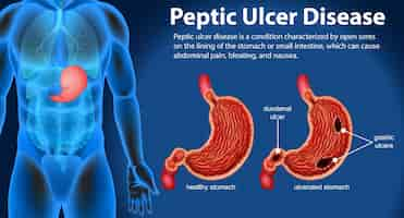 Vector gratuito infografía sobre la enfermedad de la úlcera péptica