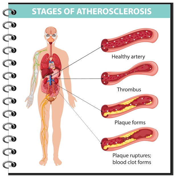 Infografía sobre las etapas de la aterosclerosis.