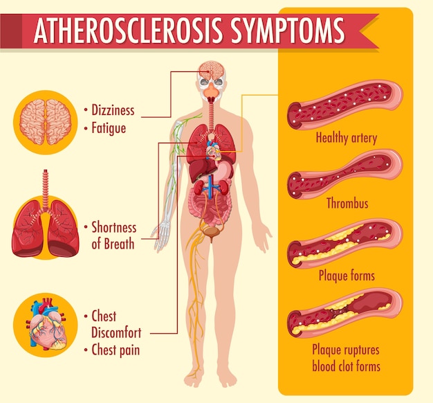 Vector gratuito infografía sobre las etapas de la aterosclerosis.