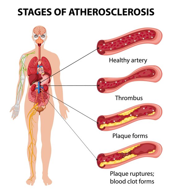 Infografía sobre las etapas de la aterosclerosis.