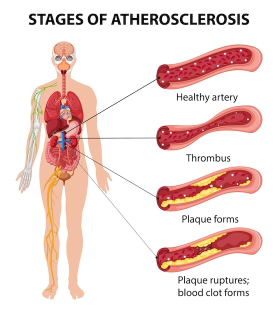 Infografía sobre las etapas de la aterosclerosis.