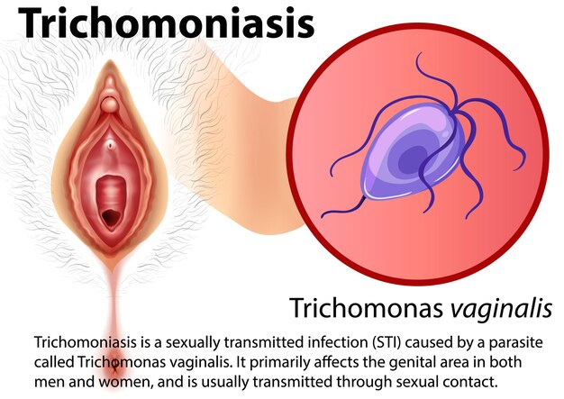 Infografía de tricomoniasis con explicación.