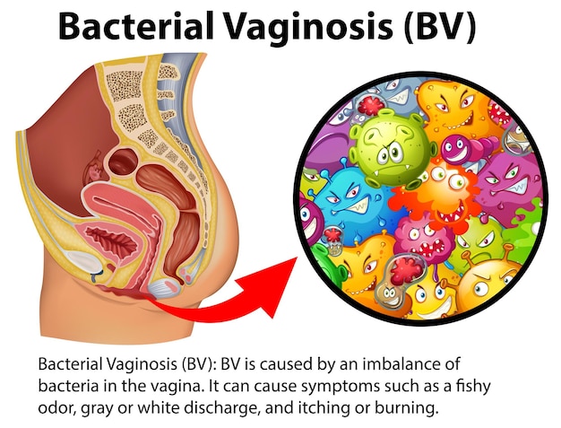 Vector gratuito infografía de vaginosis bacteriana bv con explicación