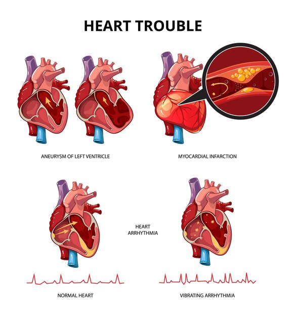 Infografía de vector de enfermedad cardíaca. Ilustración de información de infografía de corazón humano médico
