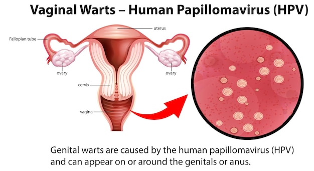 Infografía del VPH del virus del papiloma humano de las verrugas vaginales con exp
