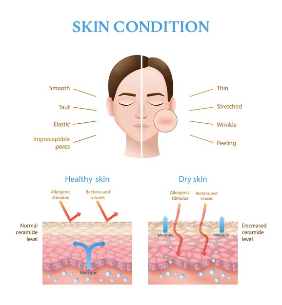 Infografías realistas que muestran la estructura de la piel humana sana y seca con ilustración vectorial de nivel de ceramida normal y disminuido