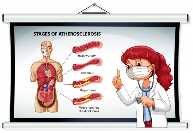Médico explicando las etapas de la aterosclerosis.