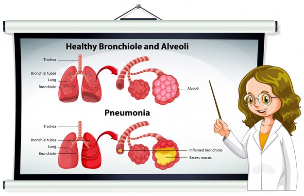 Médico explicando sanos bronquiolos y alvéolos.