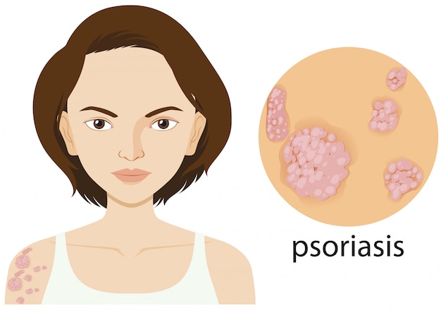 Mujer con psoriasis en cartel