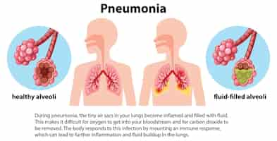 Vector gratuito neumonía por infección pulmonar con explicación.