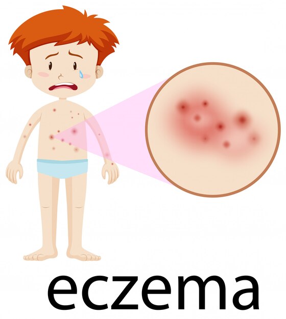 Un niño que tiene Eczema en la piel del cuerpo