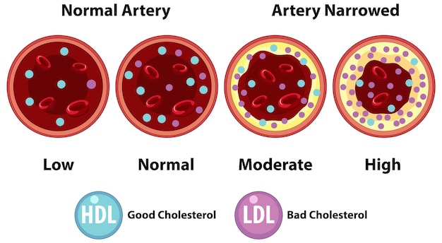 Niveles de colesterol en las arterias Ilustración