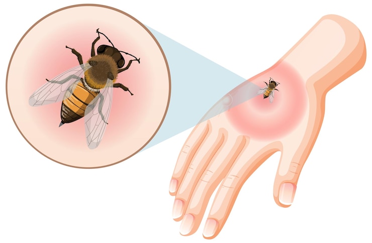 Vector gratuito picadura de abeja picadura en la piel
