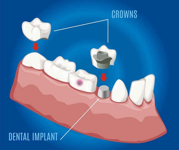 Plantilla de estomatología protésica profesional isométrica con implantes dentales y coronas sobre fondo azul aislado