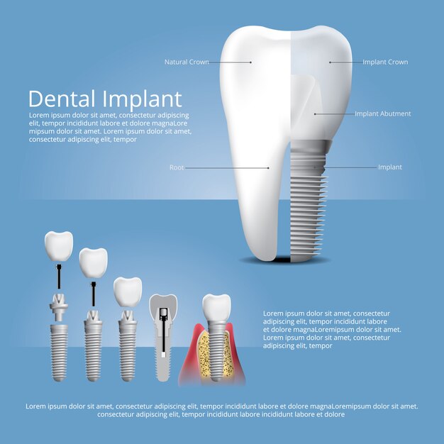 Plantilla de implante dental y dientes humanos