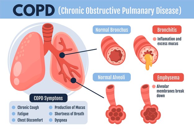 Plantilla de infografía de copd dibujada a mano plana