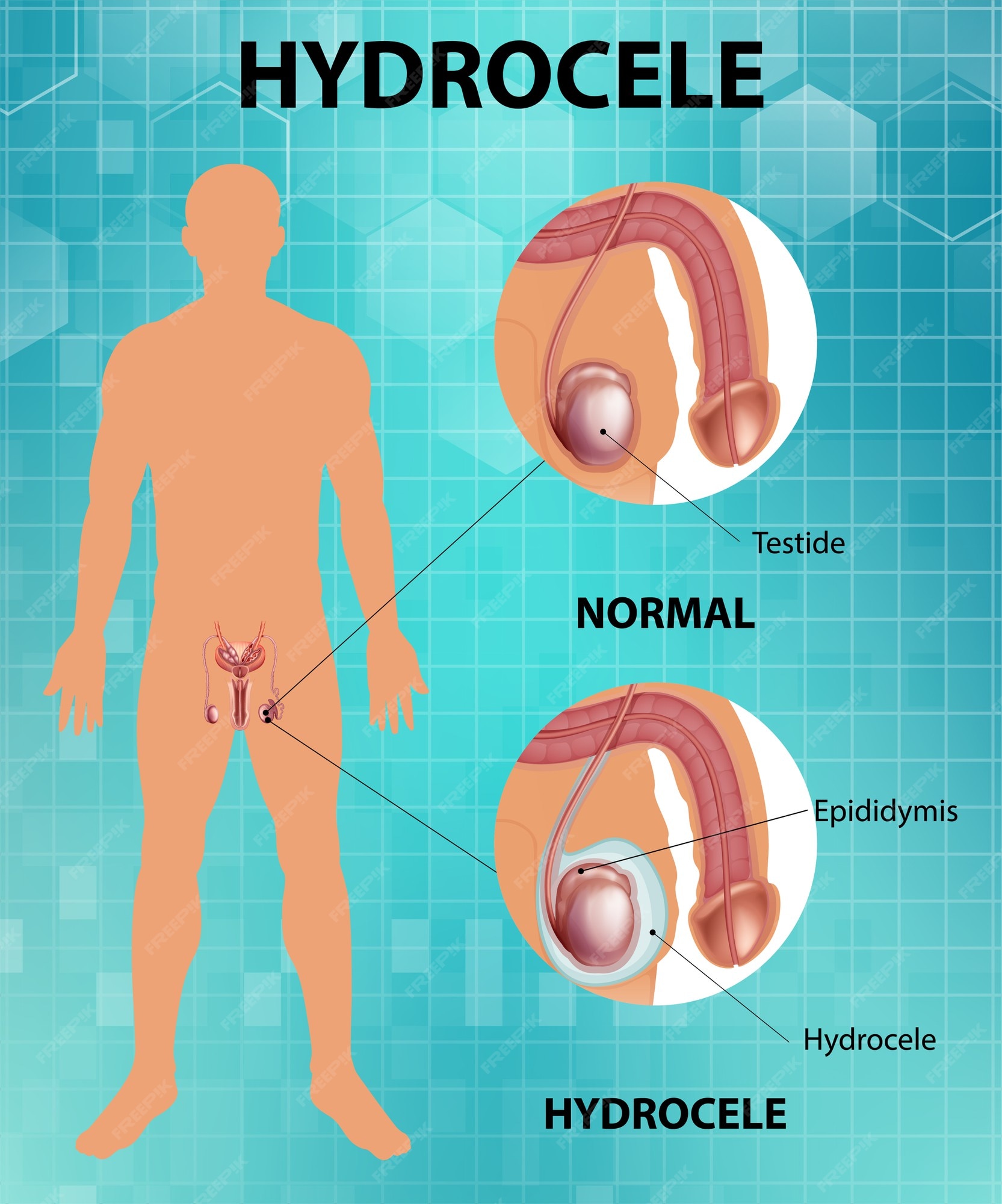 Póster médico que muestra diferencias entre testículo masculino normal e  hidrocele | Vector Gratis