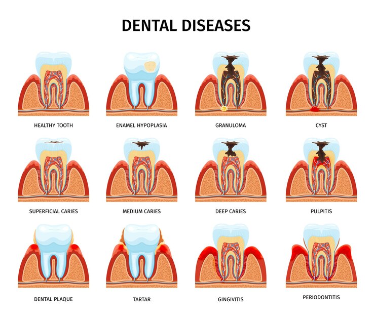 Vector gratuito problemas de anatomía de los dientes establecidos con composiciones aisladas de dientes en la mandíbula sanos y dañados con ilustraciones de vectores de texto