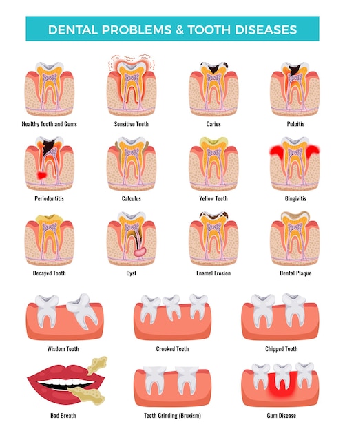 Vector gratuito problemas orales dentales conjunto infográfico educativo con caries inflamación placa dental mal aliento erosión del esmalte ilustración vectorial