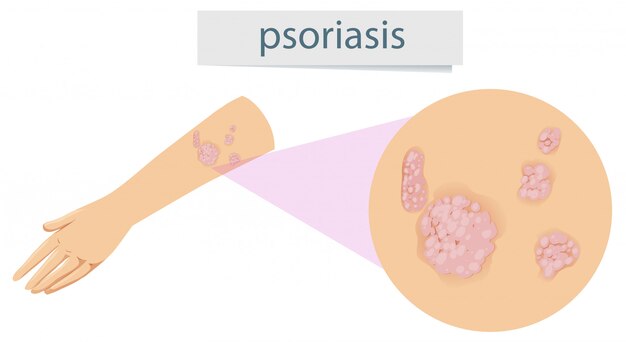 Psoriasis magnificada en el brazo