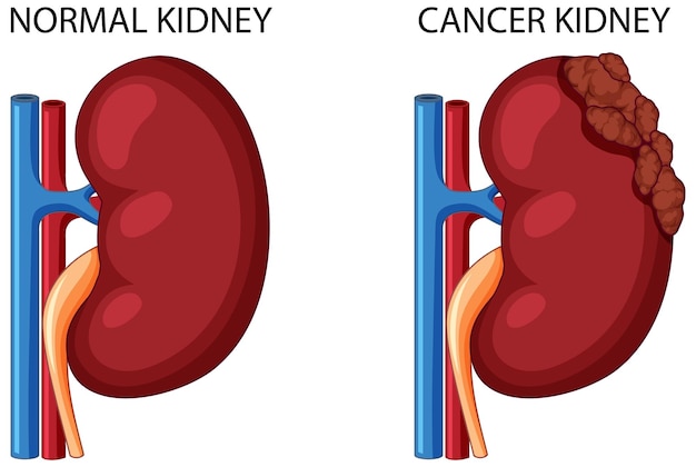 Riñón normal y riñón con cáncer