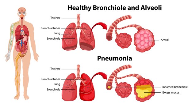 Saludables y no saludables de los pulmones humanos.