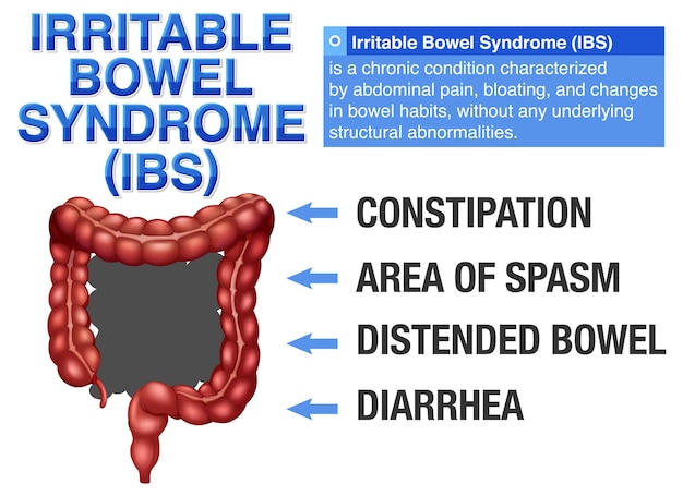 Vector gratuito síndrome del intestino irritable ibs infografía