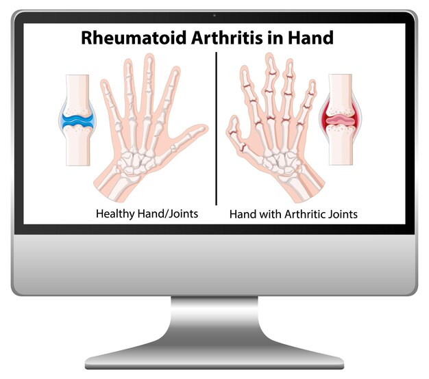 Los síntomas de la artritis reumatoide en la mano en el escritorio de la computadora