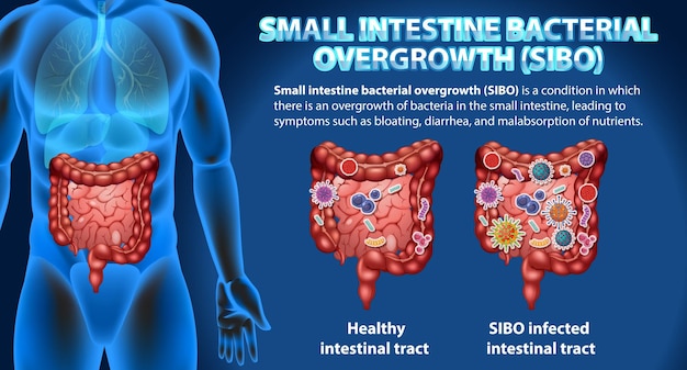 Sobrecrecimiento bacteriano del intestino delgado SIBO