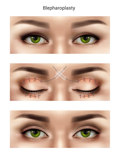 Vector gratuito la sutura quirúrgica cose una composición realista con imágenes de ojos femeninos en diferentes etapas de los procedimientos de blefaroplastia