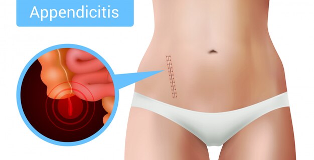 Sutura quirúrgica sutura composición realista de apendicitis con vista de la marca de intervención quirúrgica en cuerpo femenino realista