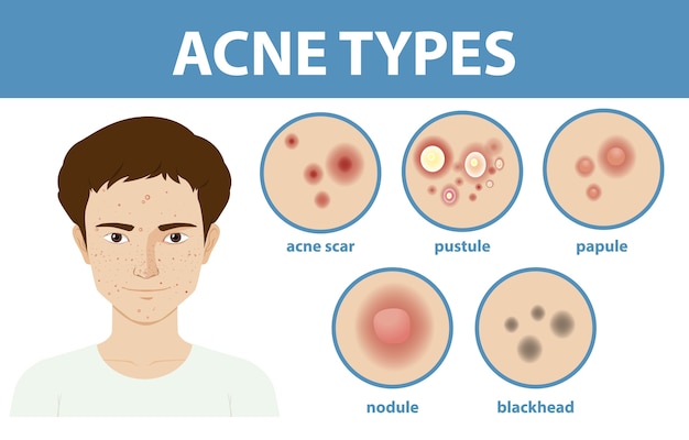 Vector gratuito tipos de acné en la piel o espinillas.