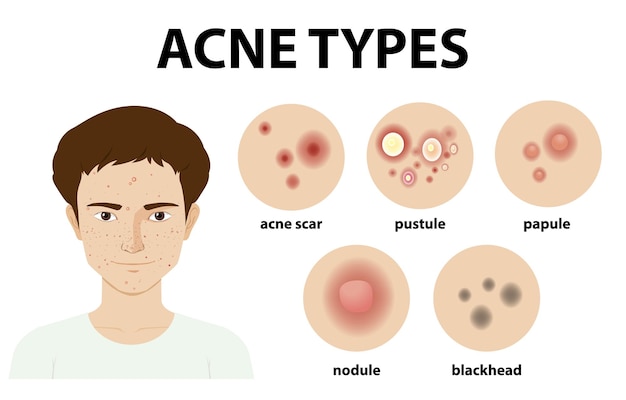 Tipos de acné en la piel o espinillas.