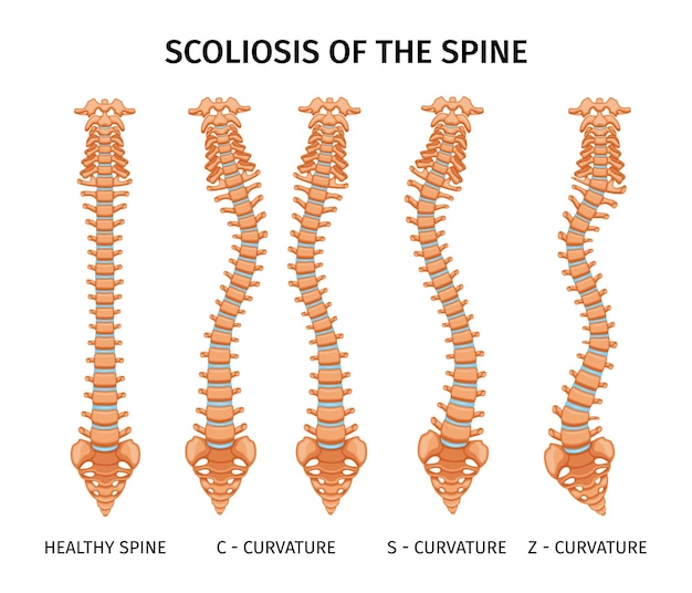 Tipos de escoliosis de infografías de columna con un conjunto de imágenes aisladas de curvatura de columna en ilustración de vectores de fondo en blanco