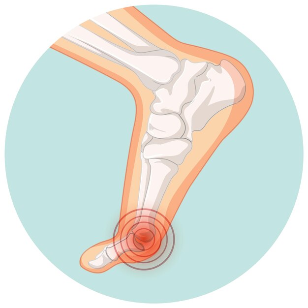 Tipos de hallux valgus en plantilla de círculo