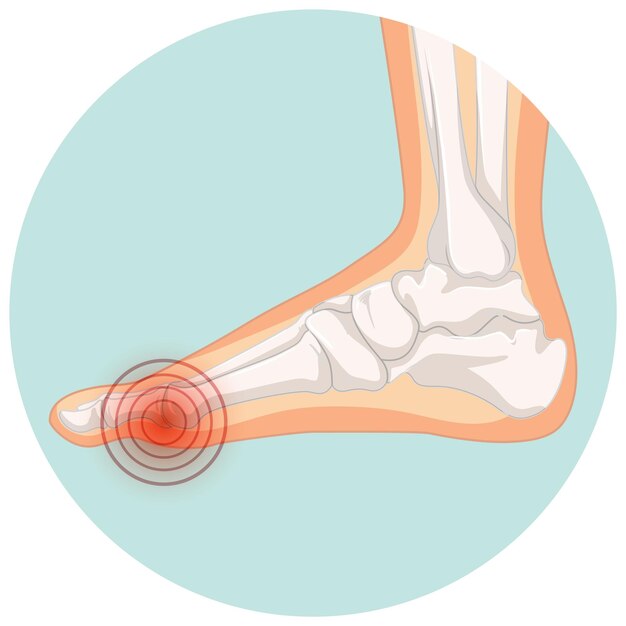 Tipos de hallux valgus en plantilla de círculo