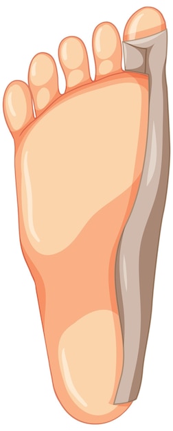 Vector gratuito tipos de hallux valgus sobre fondo blanco.