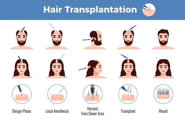 Trasplante de cabello para hombres y mujeres con etapas de operación infografía en blanco