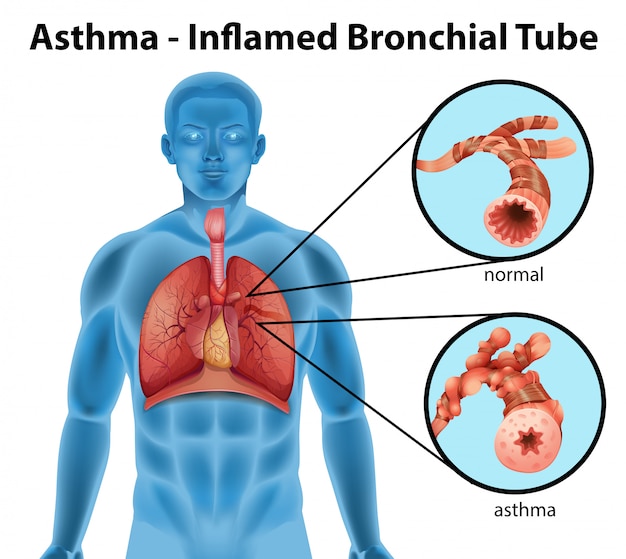 Vector gratuito tubo bronquial inflamado por asma