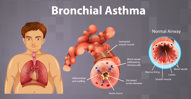 Vector gratuito tubo bronquial inflamado por asma