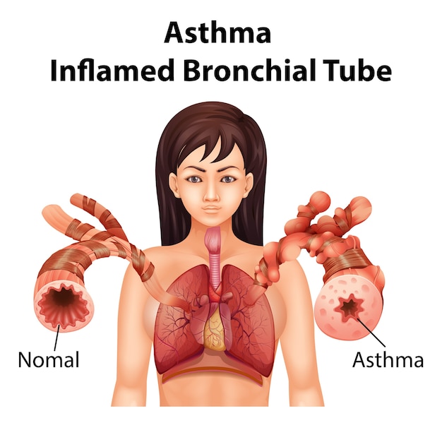 Vector gratuito tubo bronquial inflamado por asma
