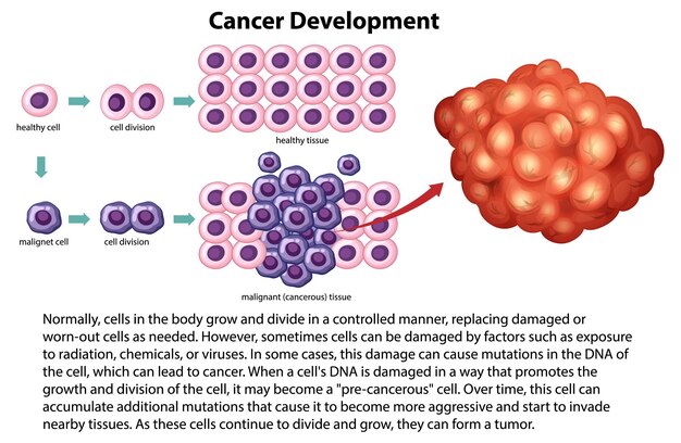 Vector de desarrollo del cáncer con información