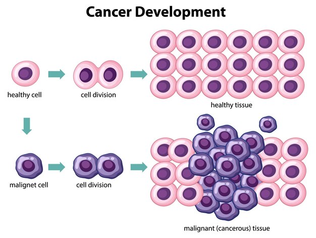 Vector de desarrollo del cáncer con información
