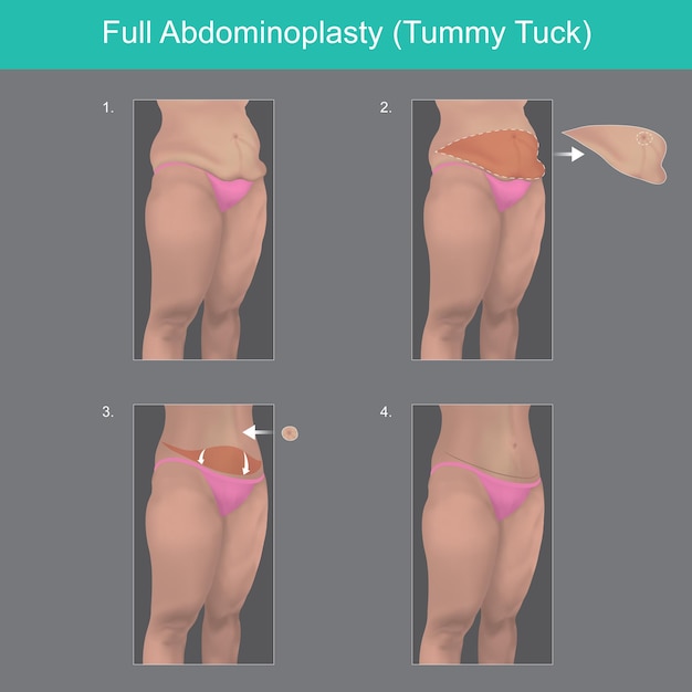 Vector abdominoplastia completa explicar para entender en pasos una cirugía de grasa corporal del vientre