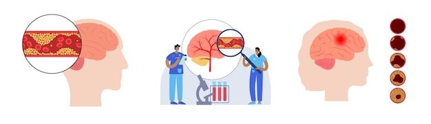 Accidente cerebrovascular isquémico arteriosclerosis infarto tia y cva colesterol en vaso sanguíneo