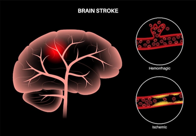 Accidente cerebrovascular isquémico y hemorrágico