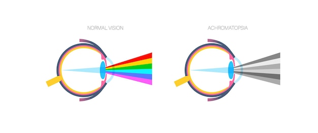 Vector acromatopsia deficiencia de la visión